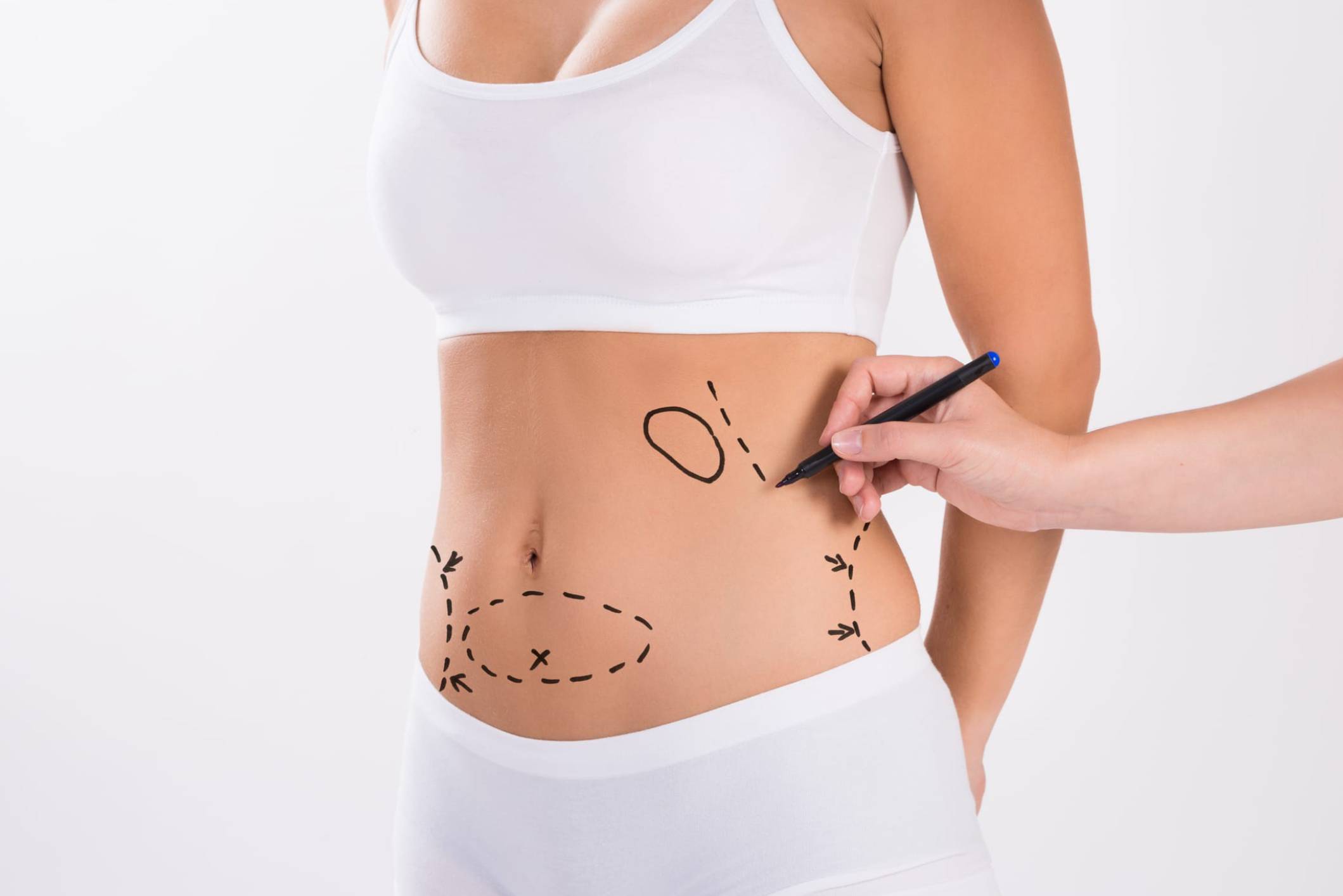 Cropped image of surgeon preparing woman for liposuction surgery over white background