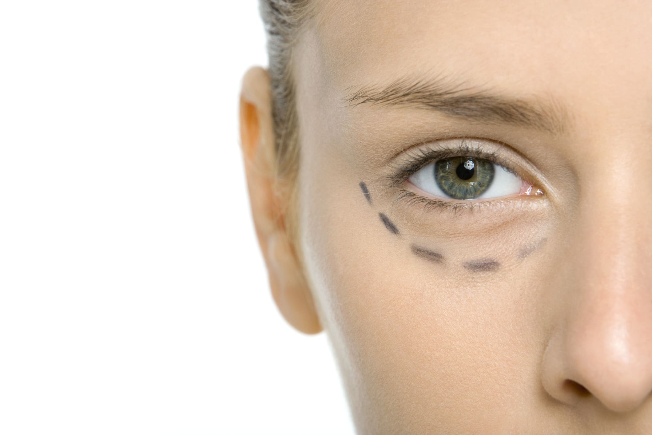 Young woman with plastic surgery markings under eye, cropped view