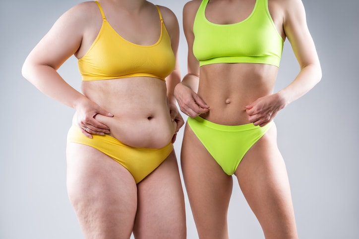 Tummy tuck patients