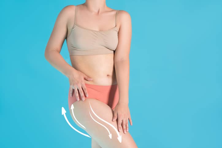 Thigh lift procedure