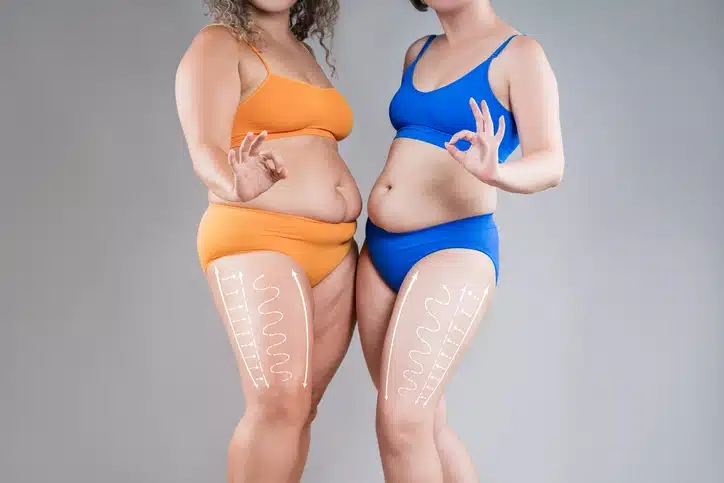 Liposuction vs emsculpt: which is best for a summer-ready body? - physique by pesta Liposuction or emsculpt?