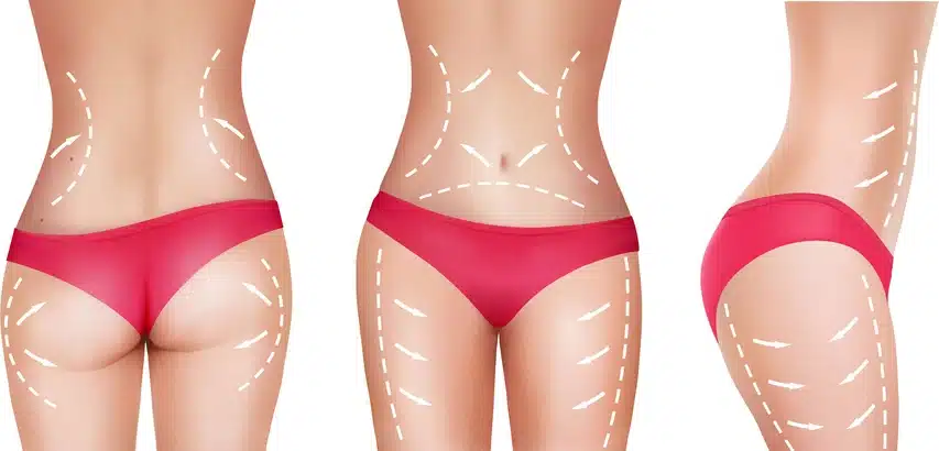 Liposuction and emsculpt